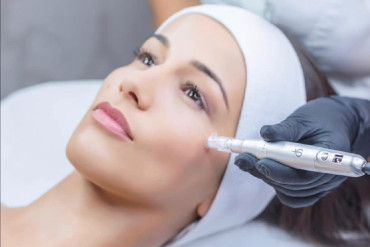 Microneedling