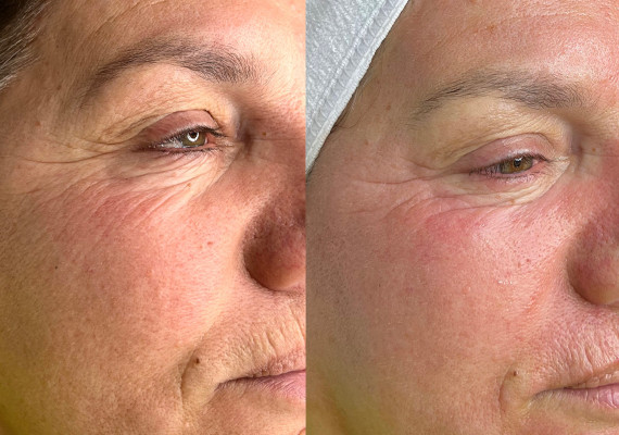 Microneedling